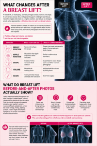 Breast Lift before and after